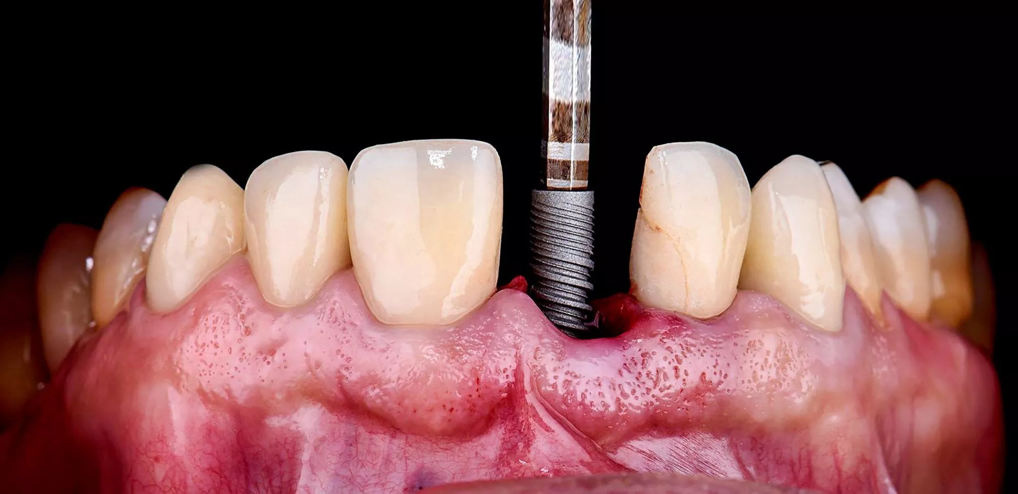 Average healing time for dental implants